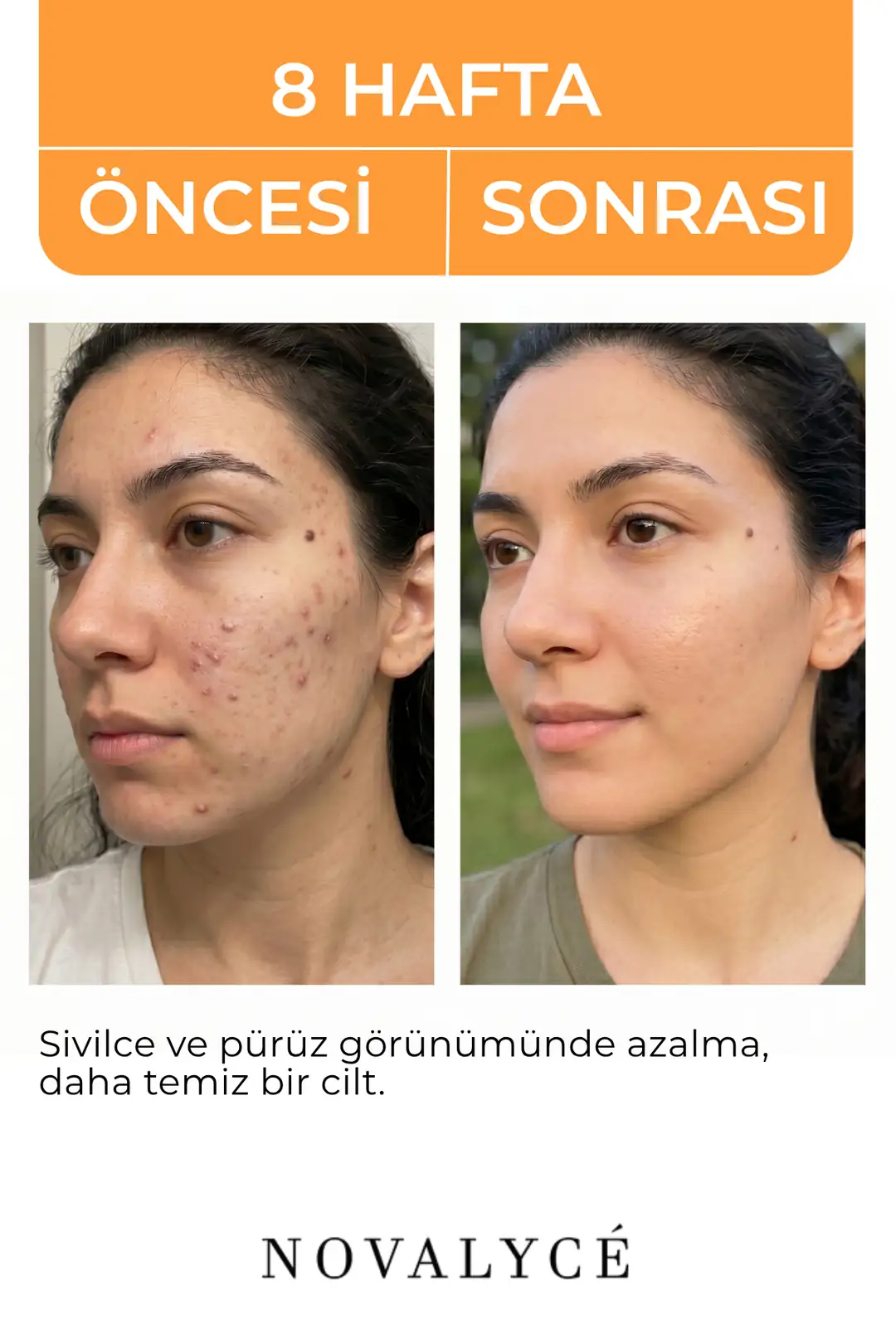 Glycolic Acid Toner Canlandırıcı Ve Gözenek Sıkılaştırıcı Tüm Ciltler Için
